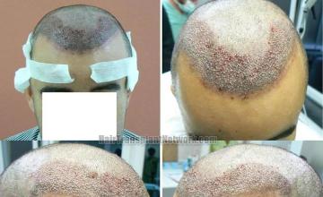 Hair restoration procedure before and after pictures