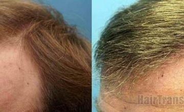 Hair transplant results viewed from left