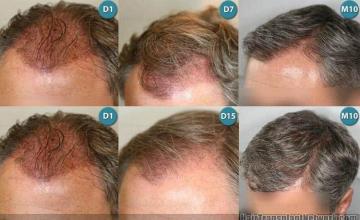Left side pictures displaying hair transplant results