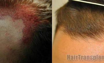 Hair restoration photos before and postoperative