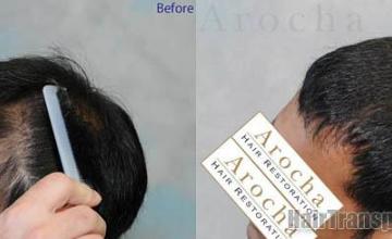 Hair transplantation surgery before and after pictures