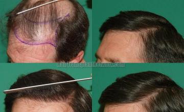 Hair transplantation surgery before and after photos