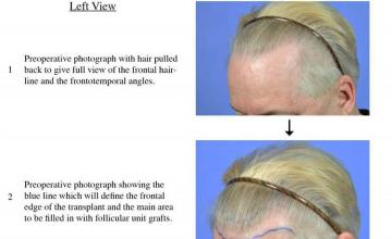 Hair transplantation surgery before and after pictures