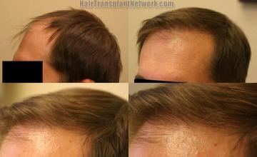 Hair transplantation surgery before and after photos