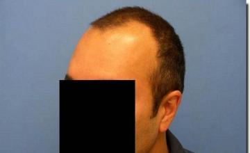 Hair restoration procedure results