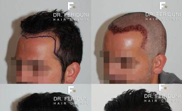 Hair restoration surgery before and after photos