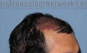 Right side hair transplant before and after result pictures