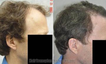 Hair transplantation surgery before and after photos