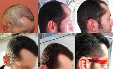 Hair transplantation surgery before and after images