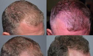 Hair transplantation surgery before and after images