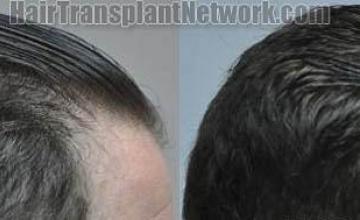 Hair transplantation surgery before and after photos