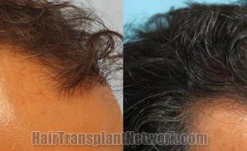 Hair transplantation surgery before and after images