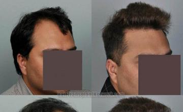 Hair transplantation surgery before and after pictures