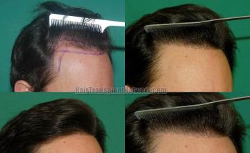 Hair transplantation surgery before and after images