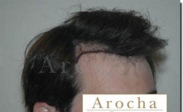 Hair restoration procedure results