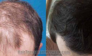 Hair replacement surgery before and after images