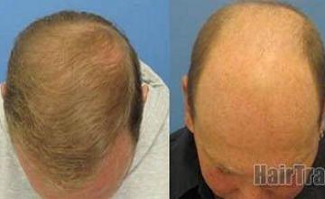  results from 4365 grafts