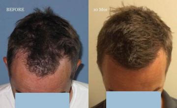 Hair transplantation surgery before and after photos