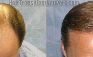 Hair transplantation surgery before and after images