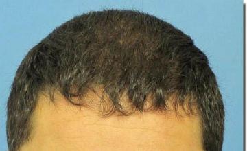 Hair restoration procedure results