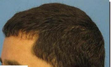 Hair restoration procedure results