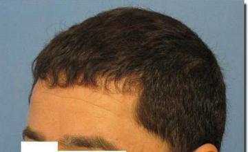 Hair restoration procedure results