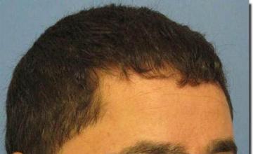 Hair restoration procedure results