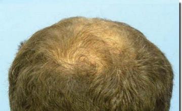 Hair restoration procedure results