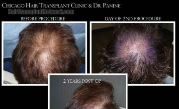 Hair restoration procedure before and after pictures