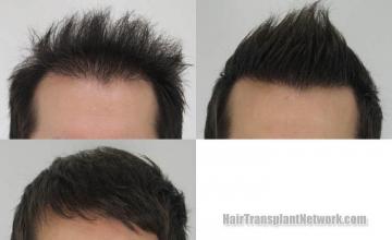 Hair transplantation surgery before and after images