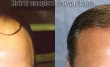 Hair transplantation surgery before and after photos