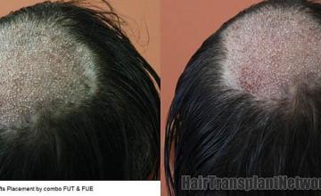 Hair transplantation surgery before and after pictures