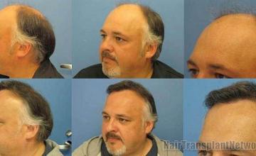 Left side photos of before and after hair transplant