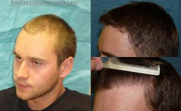 Hair restoration procedure results