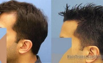 Left side profile view before and after hair transplant