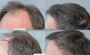 Hair transplantation surgery before and after images