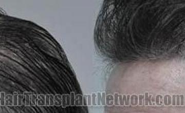 Hair transplantation surgery before and after pictures