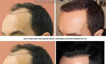 Hair restoration procedure before and after pictures