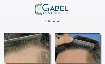 Hair restoration procedure before and after results