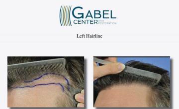 Hair transplant surgery before and after pictures