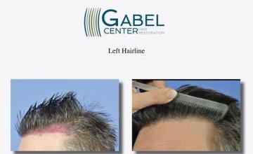 Hair transplantation surgery before and after pictures