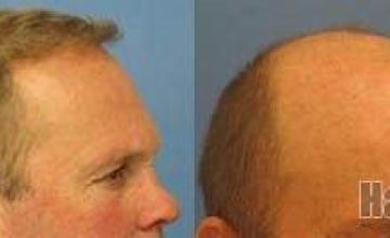 Hair transplant results from 4365 grafts