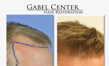 Hair transplantation surgery before and after images