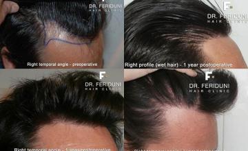 Hair restoration surgery before and after photos