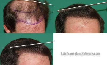 Hair restoration procedure before and after results