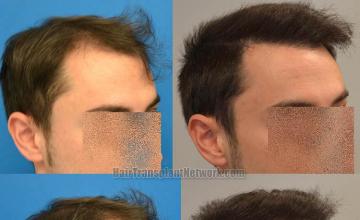 Hair transplantation surgery before and after photos