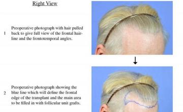 Hair transplantation surgery before and after images