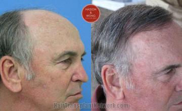 Hair transplantation surgery before and after images