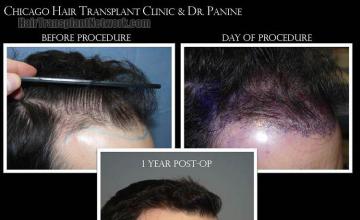 Hair transplantation surgery before and after pictures