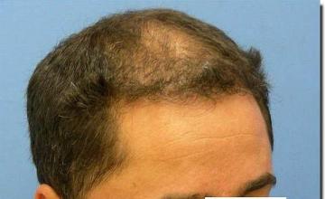 Hair restoration procedure results